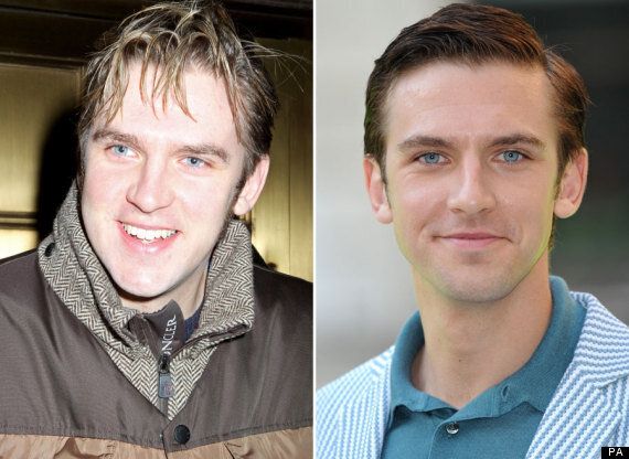 Image of Dan Stevens before and after his weight loss