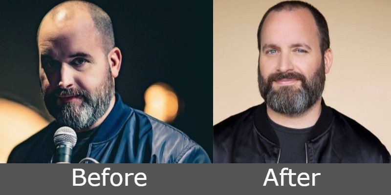 Image of Tom Segura before and after of weight loss