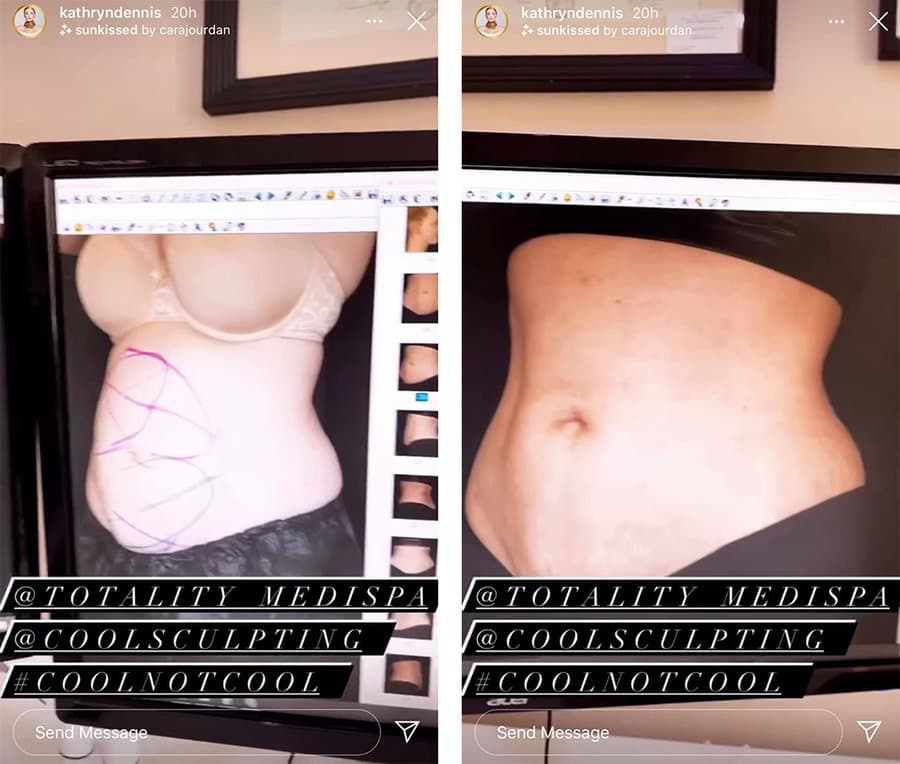 Image of Kathryn Dennis' weight loss surgery